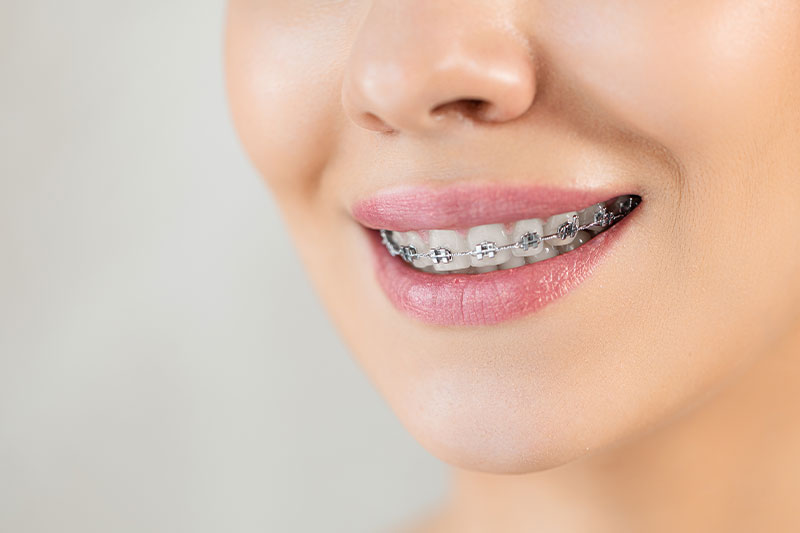 Super Smile Orthodontics Special Offer