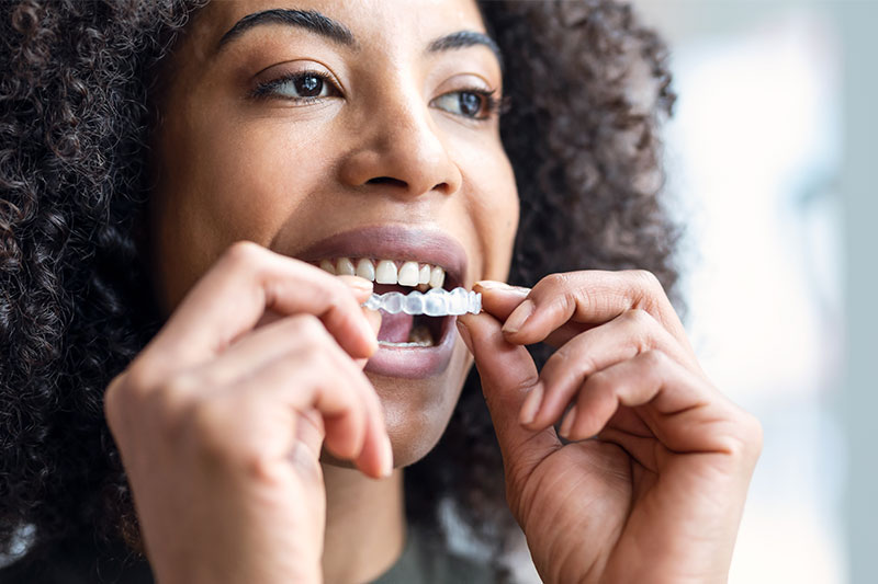 Clear Aligner Therapy in Corona