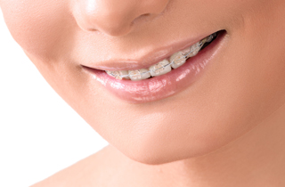 orthodontics in Corona