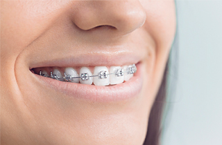 Best dental braces in Corona