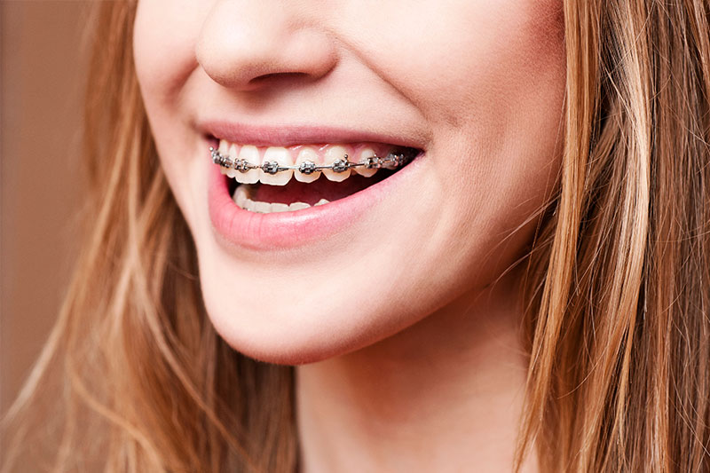 Super Smile Orthodontics Special Offer