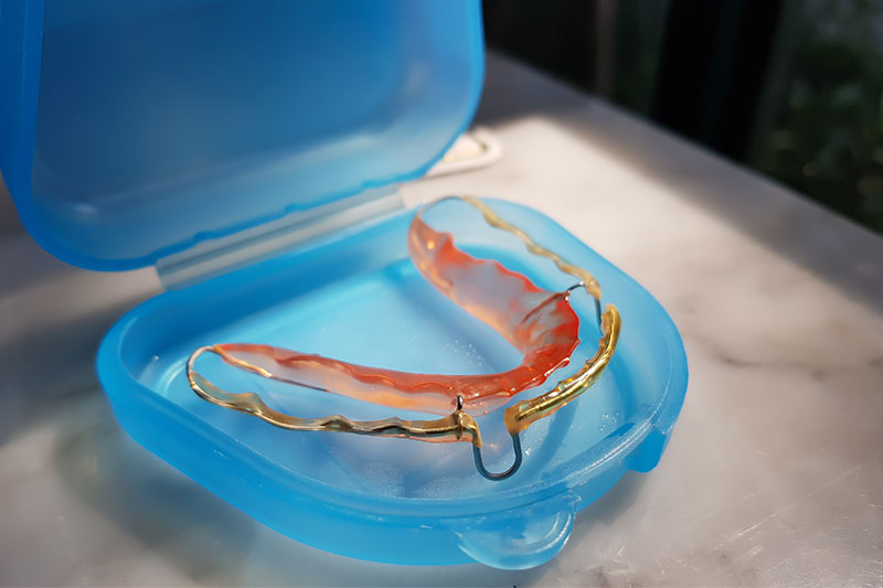 Retainers in Corona