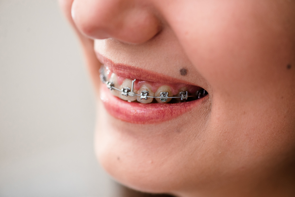 What To Expect At Your First Orthodontist Appointment